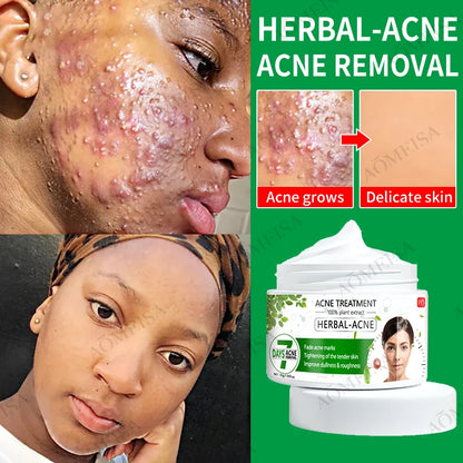 Acne Cream Herbal Essence Anti-Inflammatory, Anti-Acne, Anti-Acne, Anti-Acne, Oil Control, Suitable for All Kinds of Acne